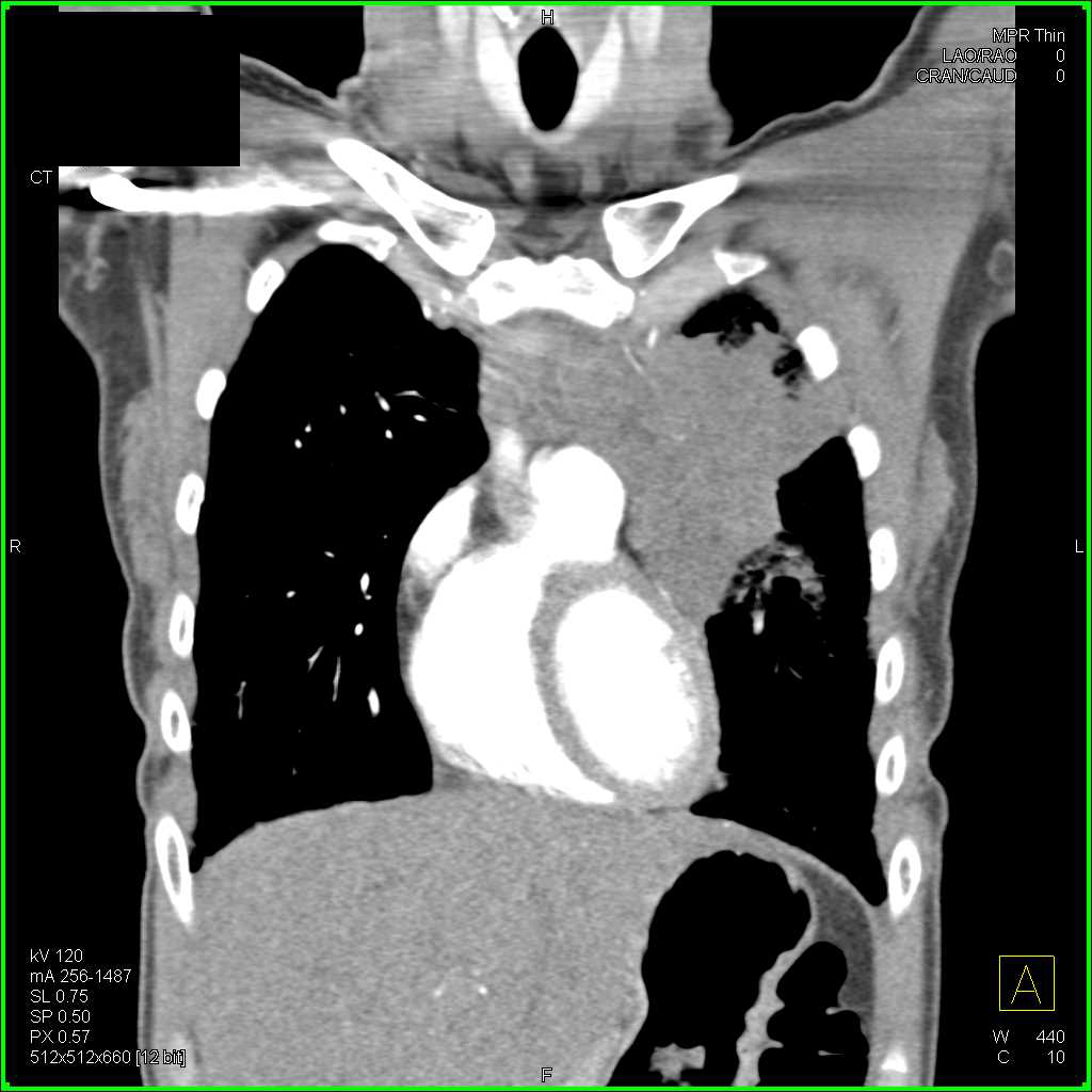 Lymphoma Involves the Chest Wall Chest Case Studies CTisus CT Scanning