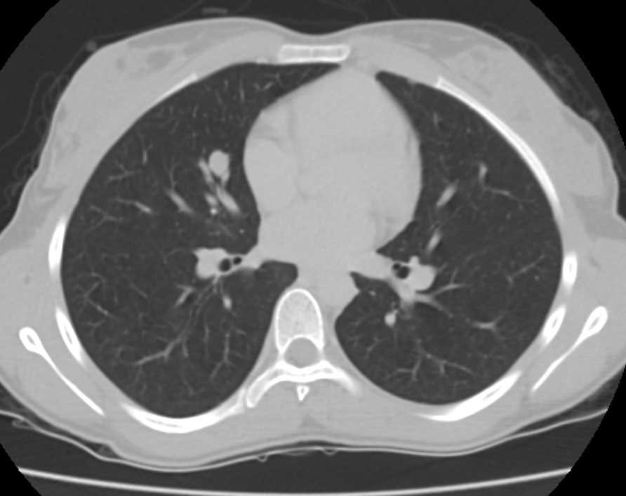 Metastatic Breast Cancer to Lung and Pleura Chest Case Studies CTisus CT Scanning