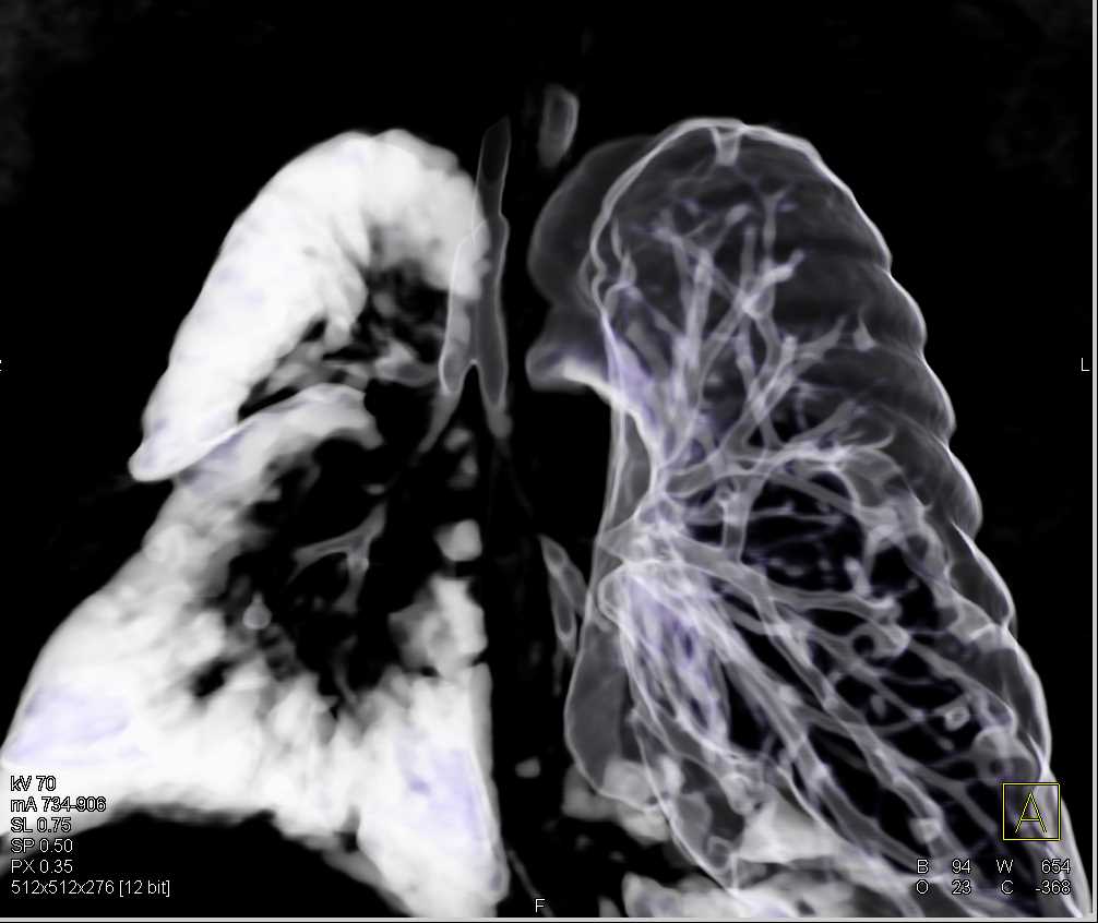 Hypoplastic Right Lung Chest Case Studies CTisus CT Scanning