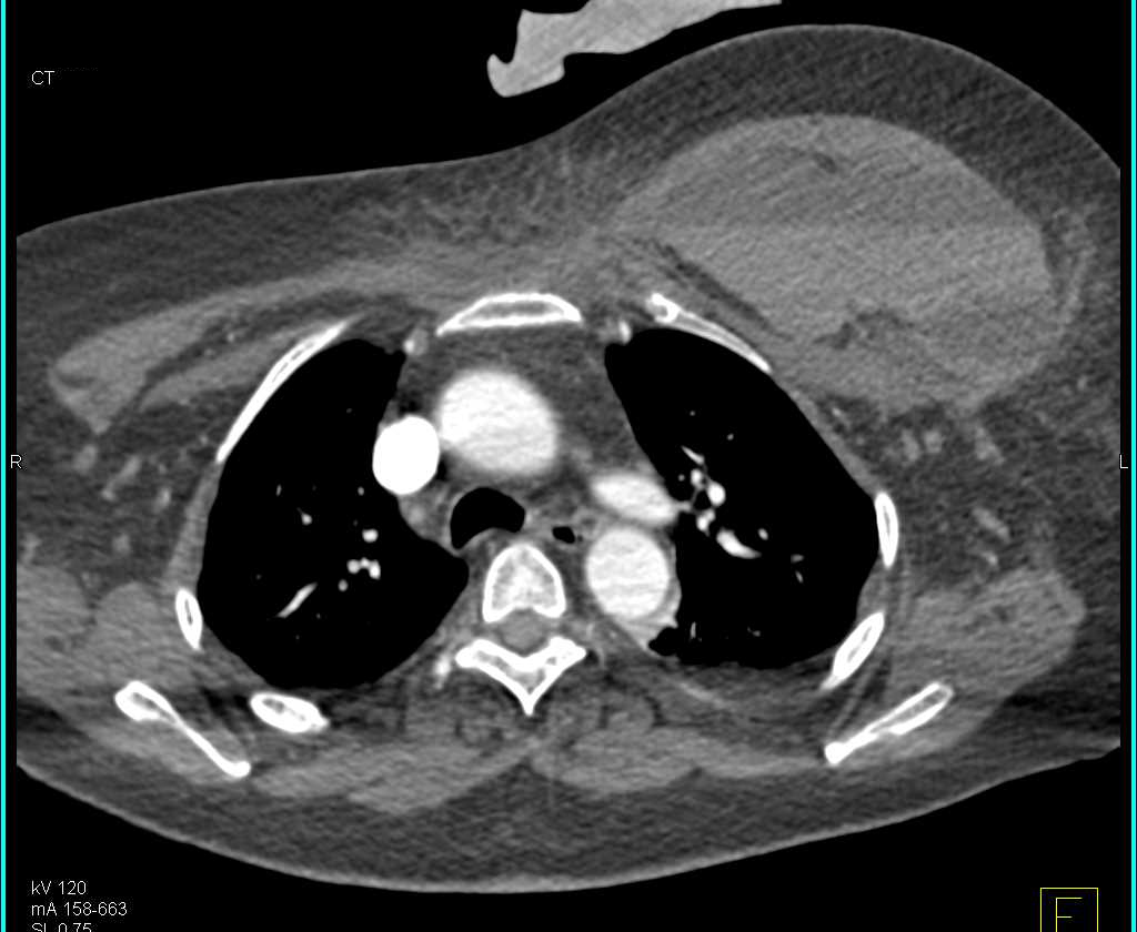 Hematoma with Fluid Fluid Level in the Left Breast Chest Case Studies