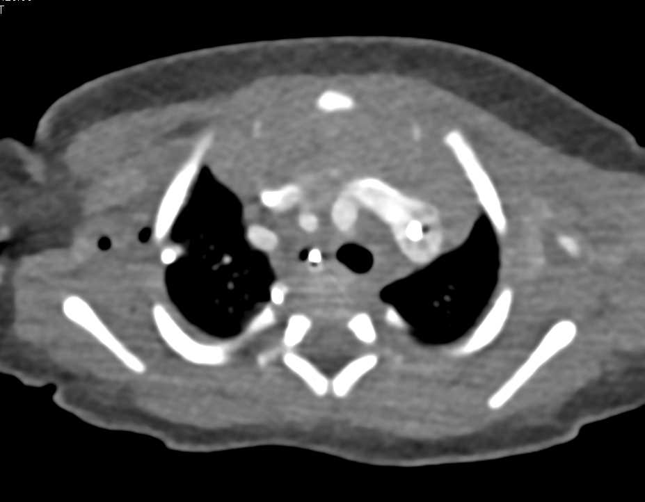 Thymus in Child Chest Case Studies CTisus CT Scanning