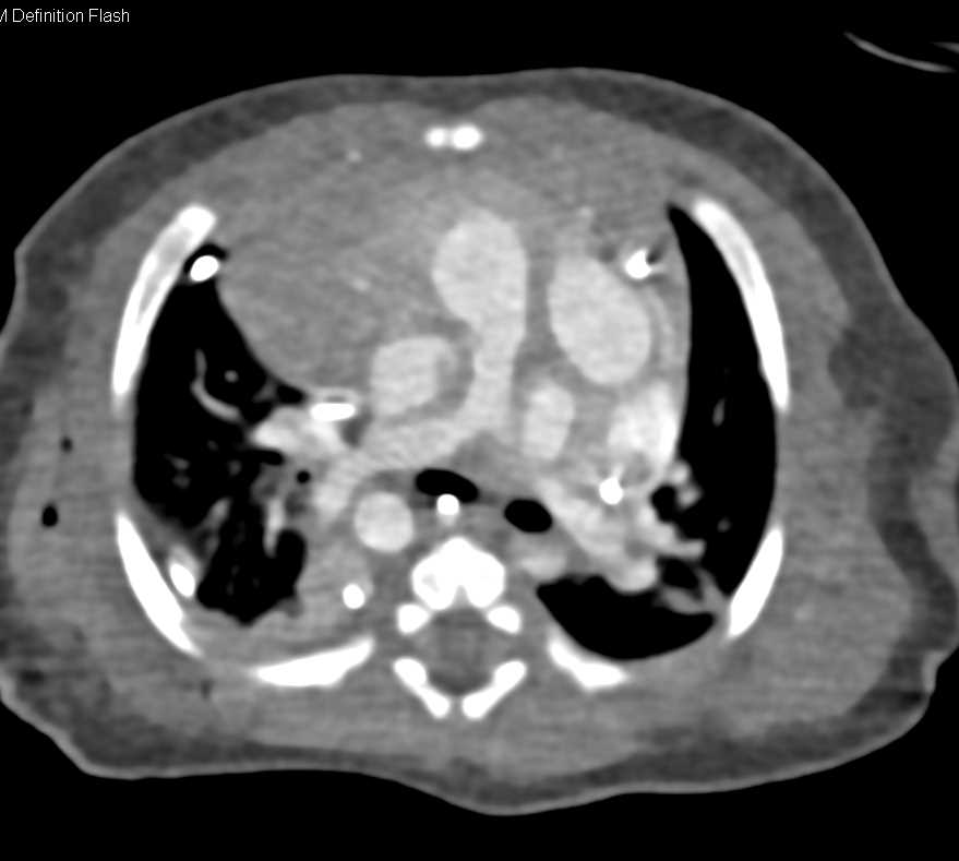 Thymus in Child Chest Case Studies CTisus CT Scanning
