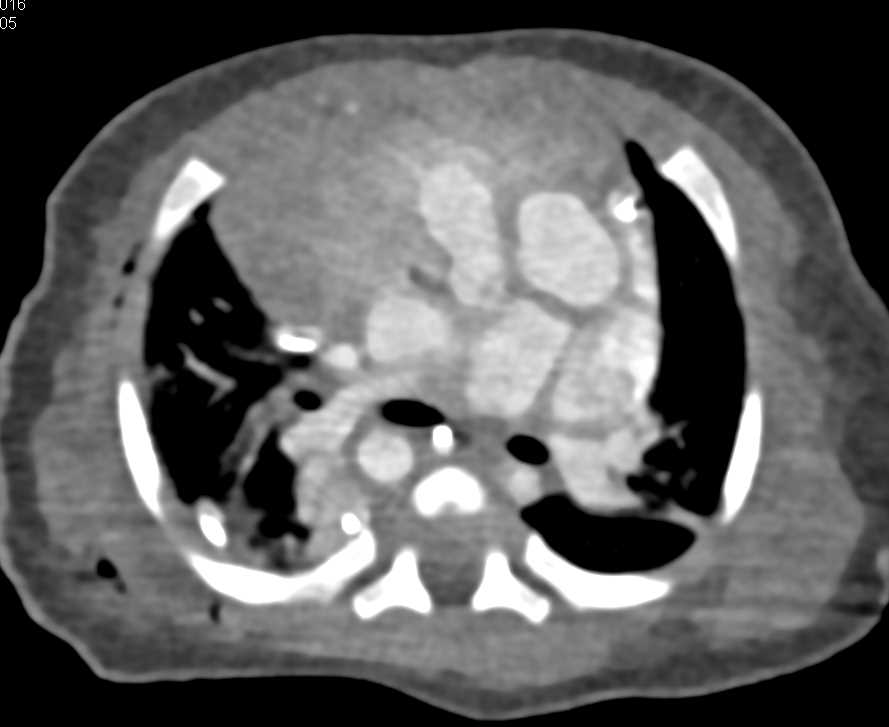 Thymus in Child Chest Case Studies CTisus CT Scanning