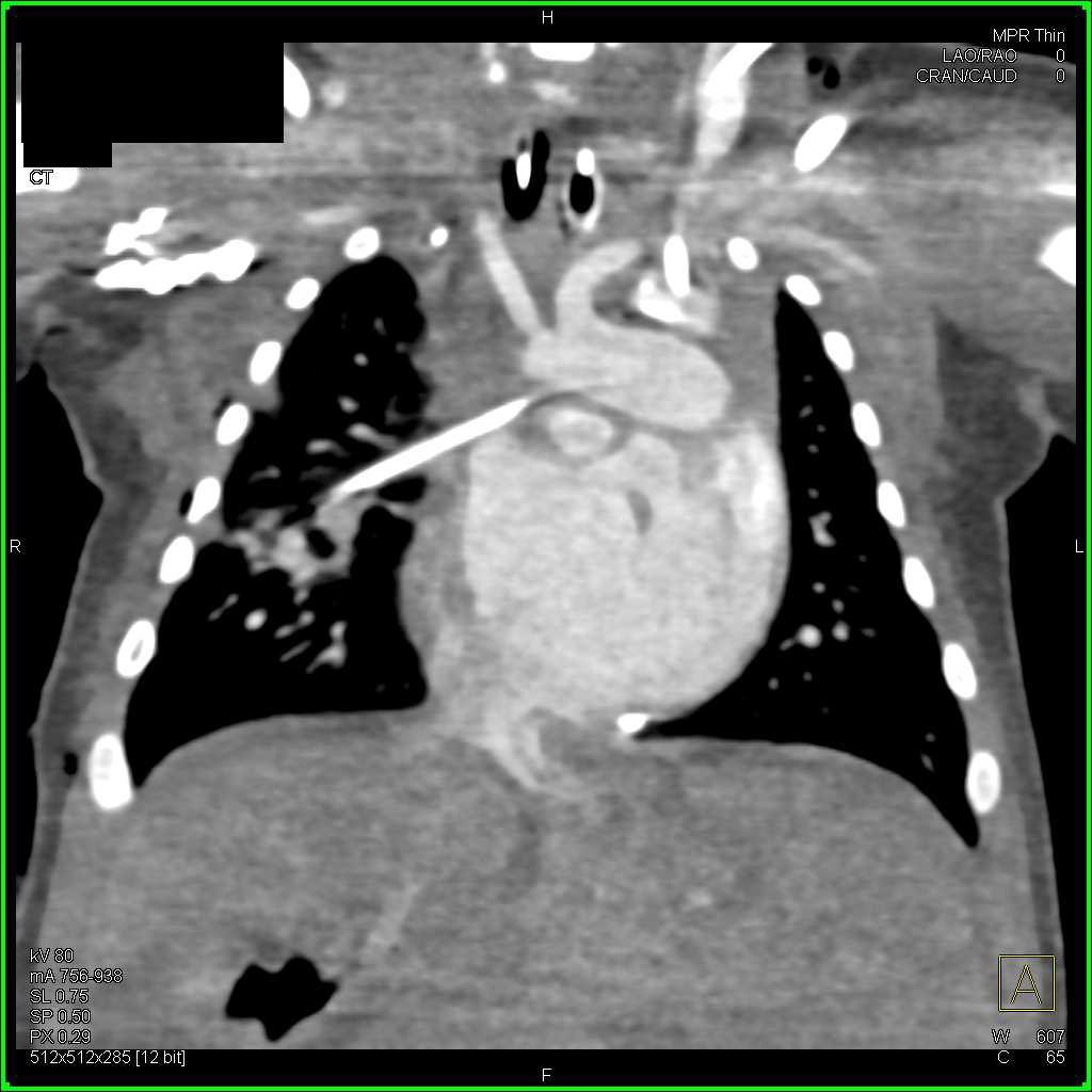 Thymus in Child Chest Case Studies CTisus CT Scanning
