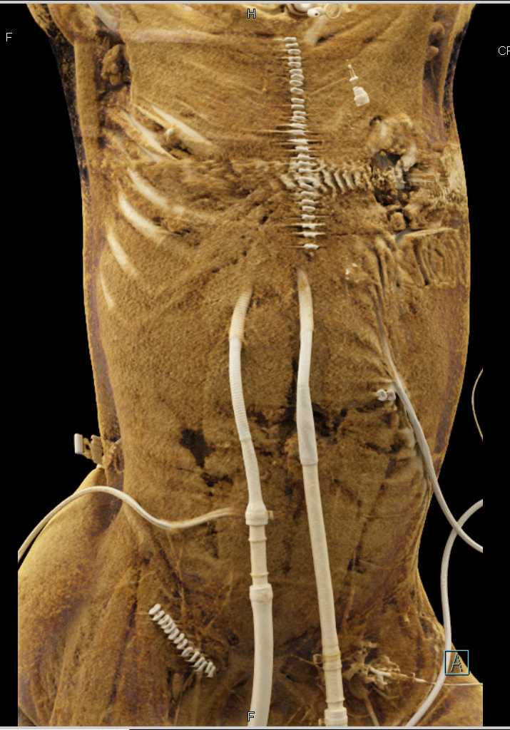 Post Cardiac Surgery with Drains in Place Chest Case Studies CTisus