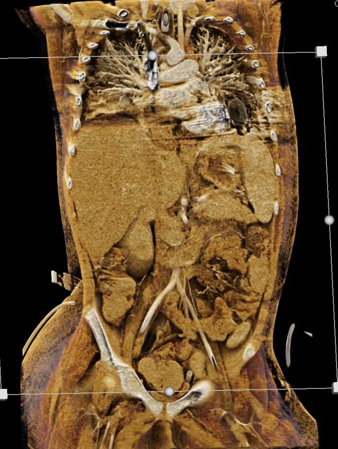 Post Cardiac Surgery with Drains in Place Chest Case Studies CTisus