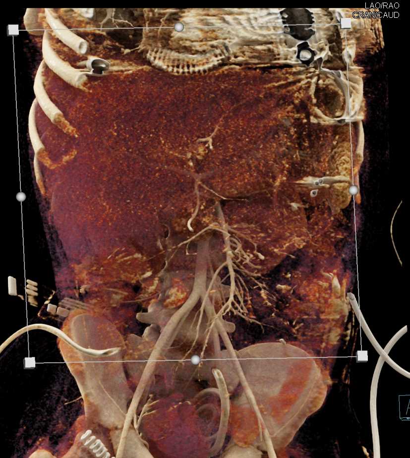 Post Cardiac Surgery with Drains in Place Chest Case Studies CTisus
