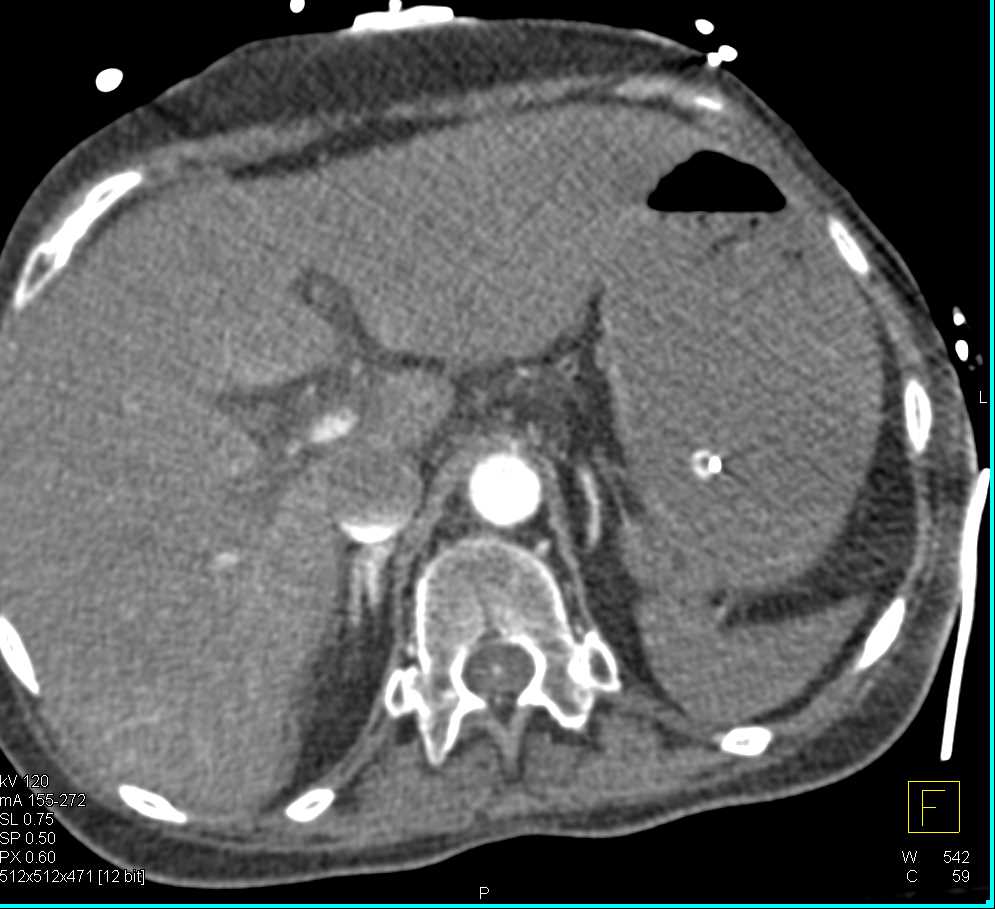 Saddle Pulmonary Embolism (PE) with Bright Adrenals due to