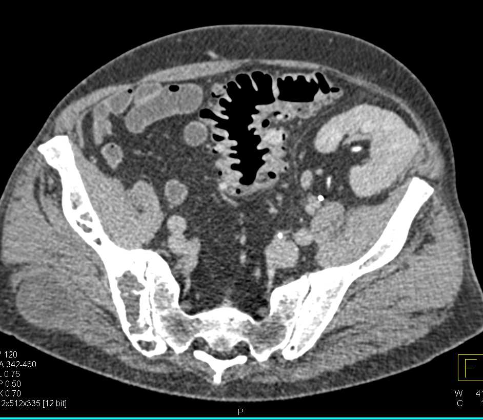 CT Cystogram with Colon Cancer Invading the Bladder
