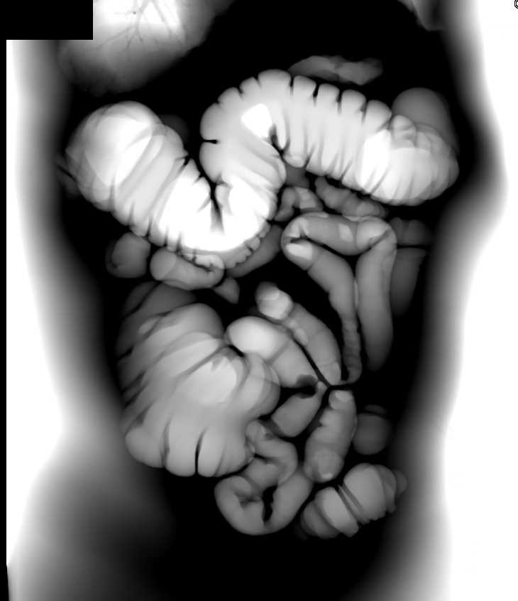 Polyp in Tortuous Descending Colon Which is on a Stalk Colon Case