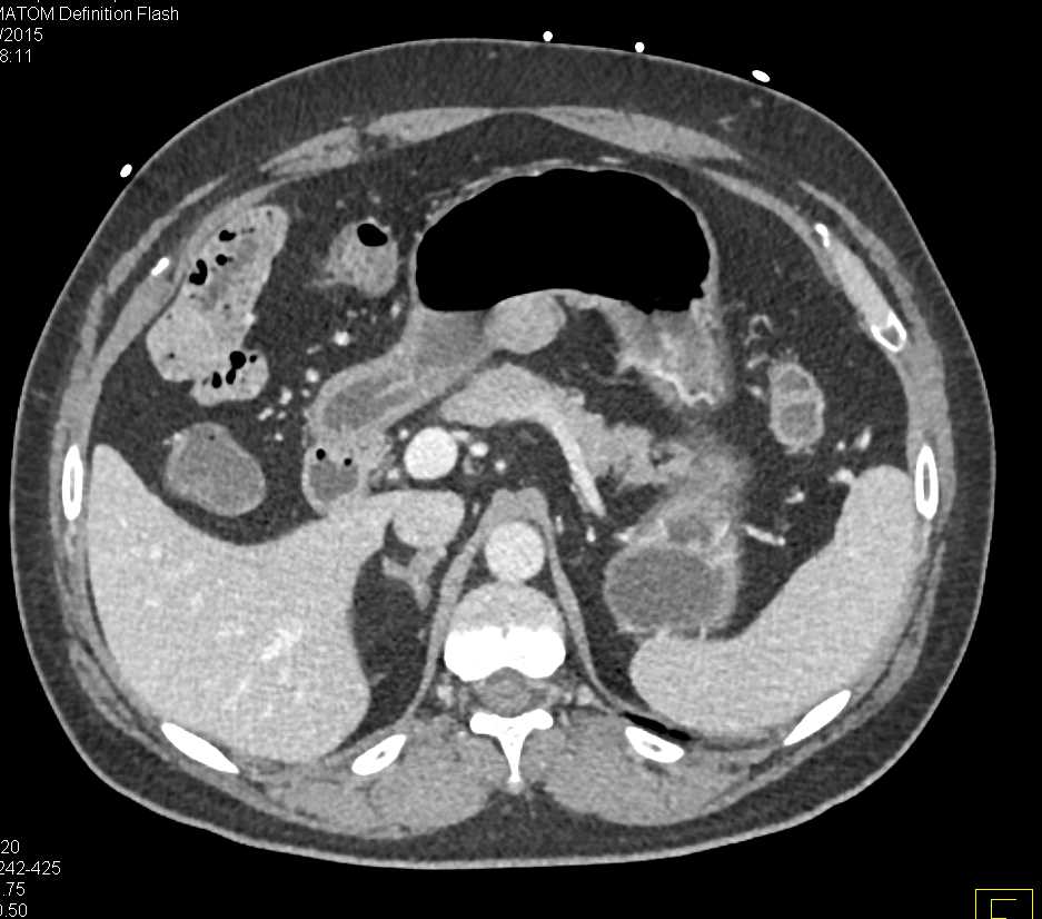 Colitis Right Colon Colon Case Studies CTisus CT Scanning