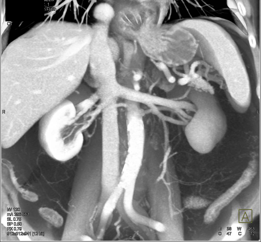 Large Hiatal Hernia Esophagus Case Studies CTisus CT