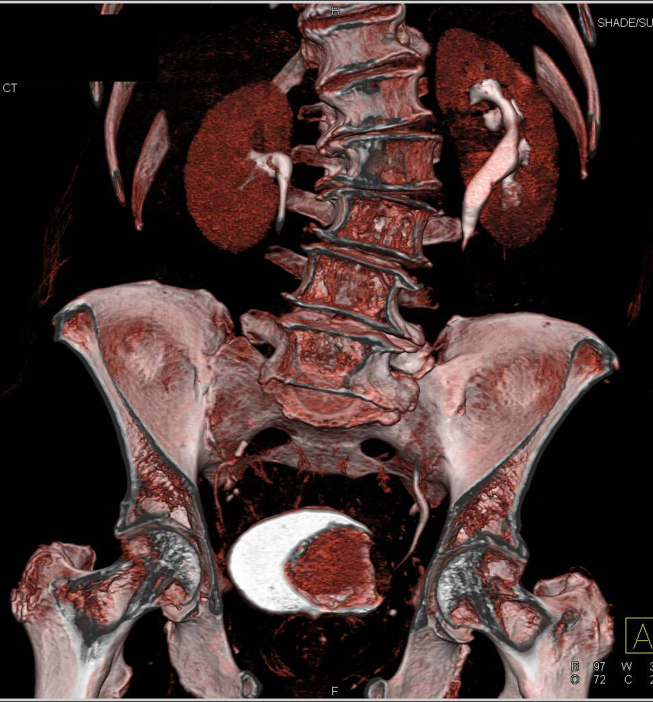 Bladder Cancer with CT Urography Genitourinary Case Studies CTisus
