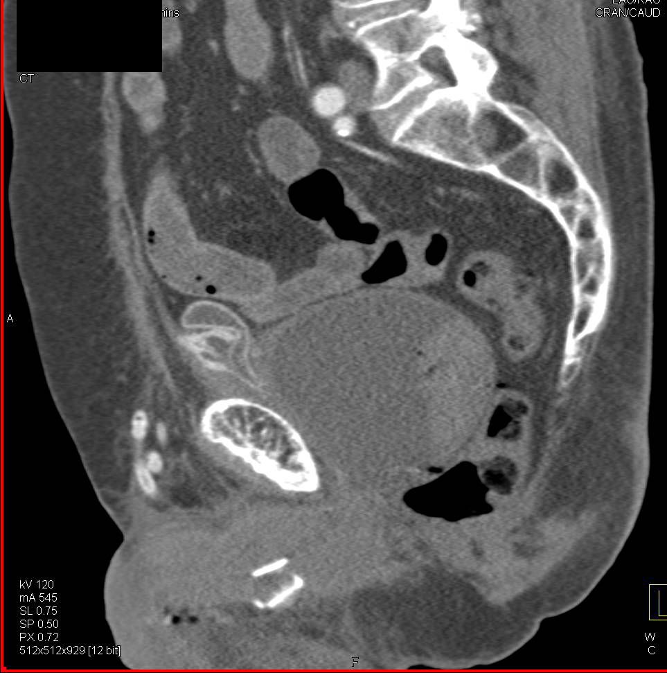 Normal Bladder Genitourinary Case Studies CTisus CT Scanning