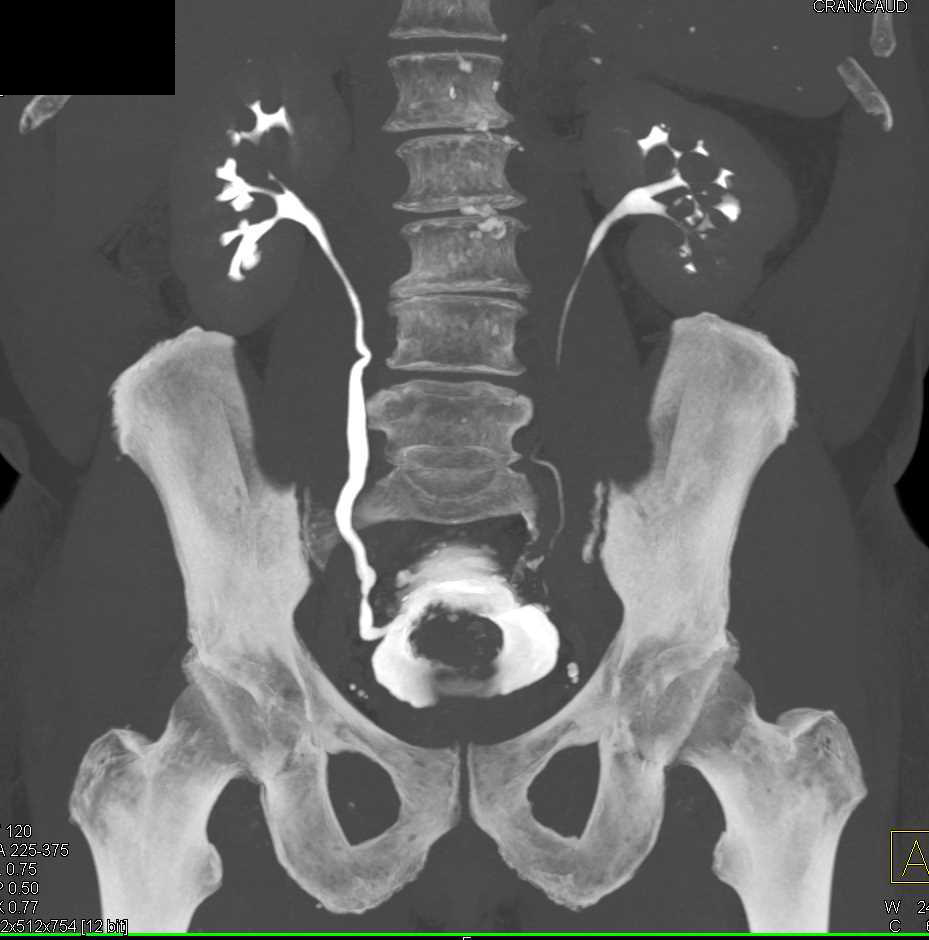 Enlarged Prostate with Bladder Outlet Obstruction Genitourinary Case
