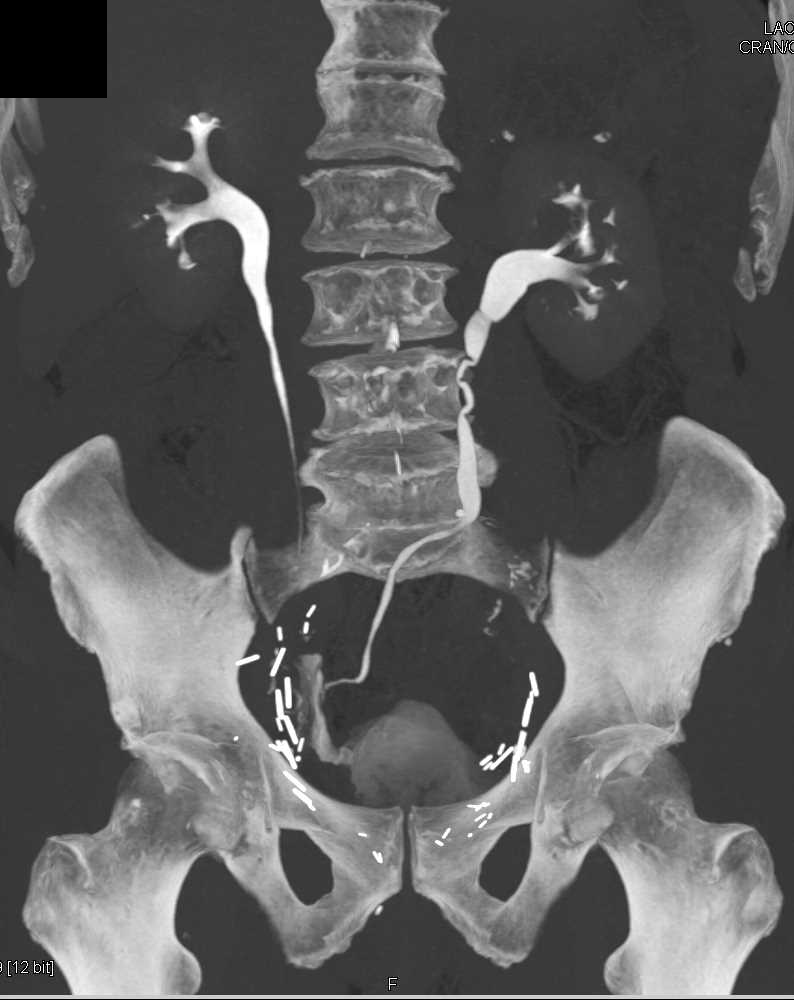 CT Urography with Neobladder Genitourinary Case Studies