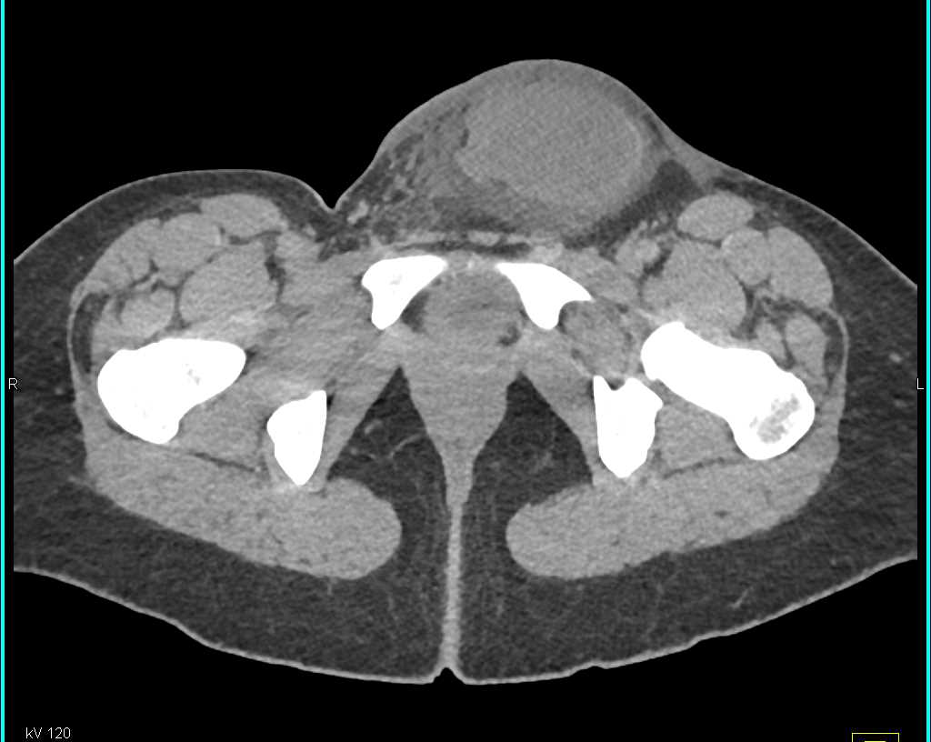 Scrotal Hematoma Following Trauma Genitourinary Case Studies CTisus