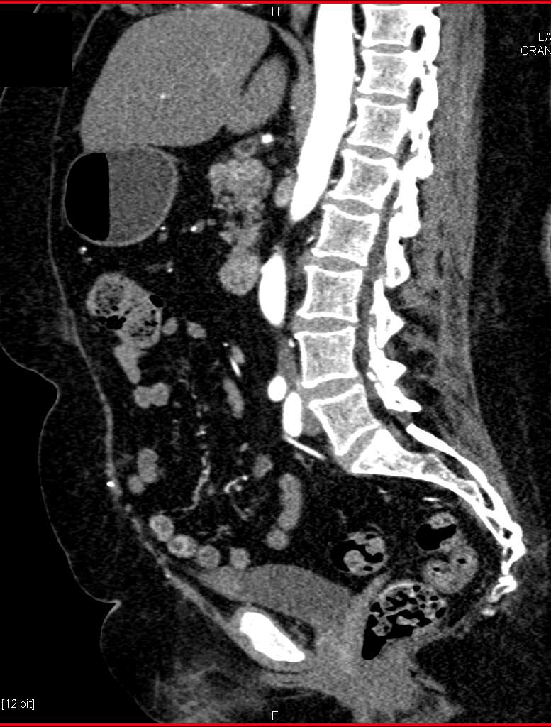 Bladder Cancer in the Anterior Dome of the Bladder Genitourinary Case