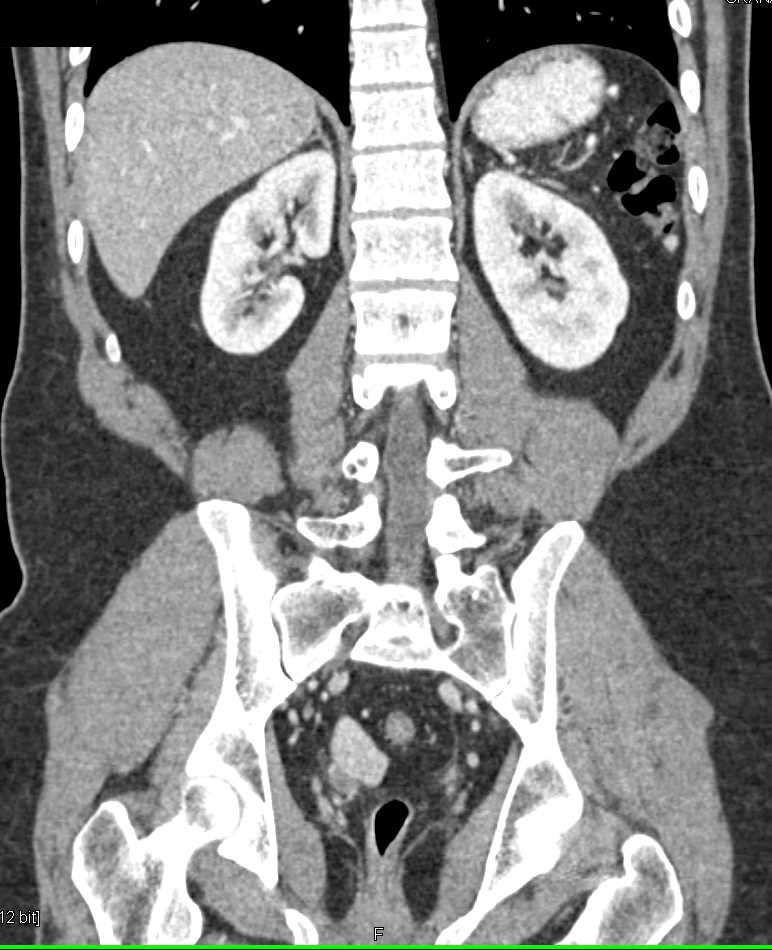 Testicular Cancer with Low Density Adenopathy Genitourinary Case
