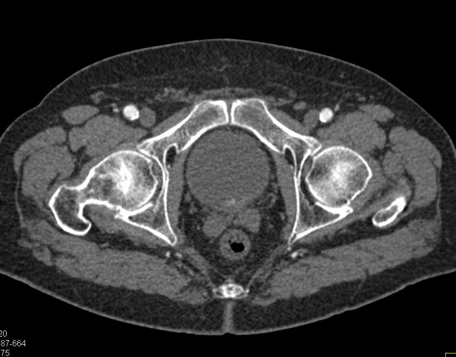 Incidental 1cm Bladder Cancer Genitourinary Case Studies