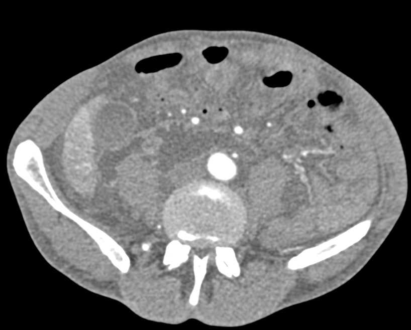 Scrotal Abscess with Incarcerated Hernia Genitourinary Case Studies CTisus CT Scanning