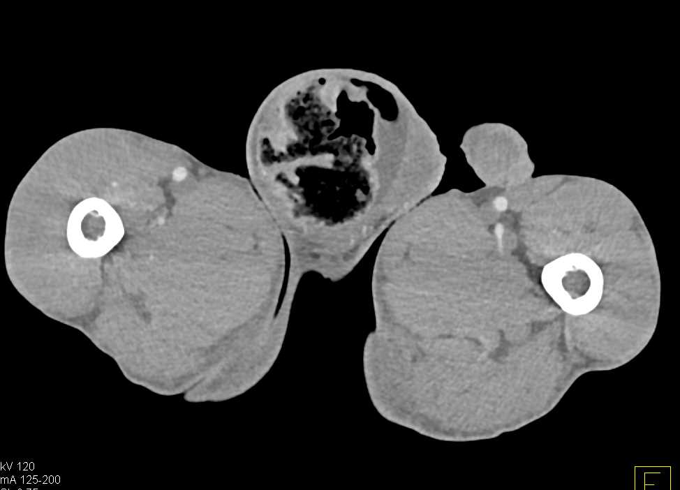 Scrotal Abscess with Incarcerated Hernia Genitourinary Case Studies CTisus CT Scanning