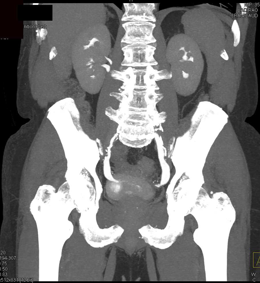 Bladder Cancer Genitourinary Case Studies CTisus CT Scanning