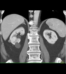 Renal Cysts Including 1 Cm High Density Right Renal Cyst - Kidney