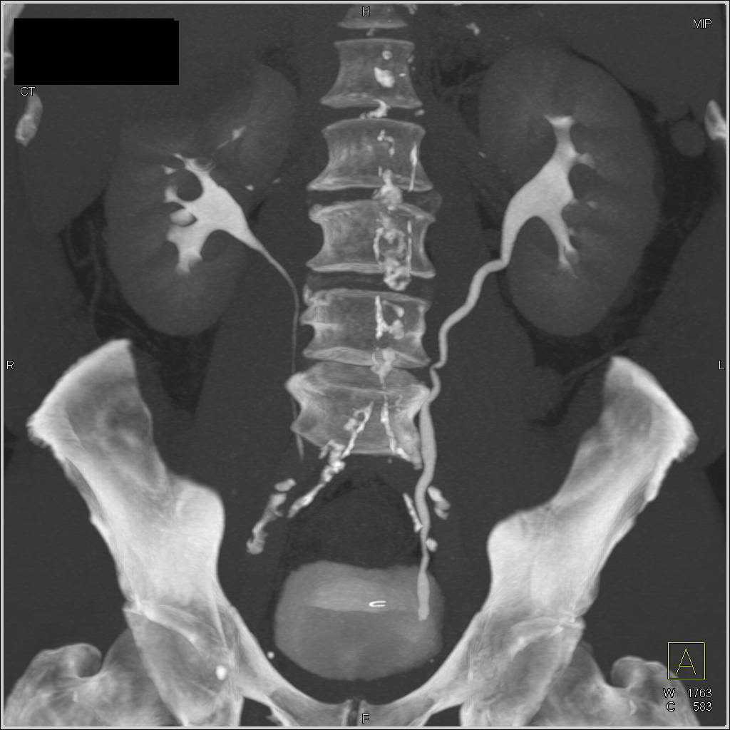 Bilateral Renal Cell Carcinoma with CT Urography Kidney
