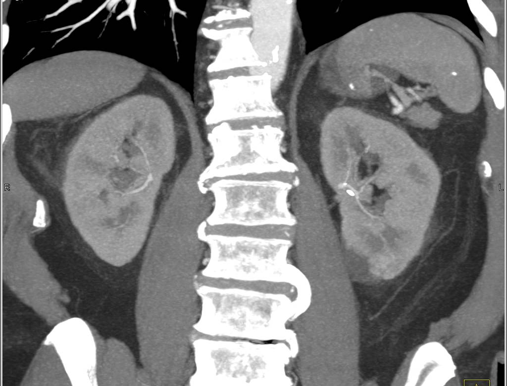 1 cm Renal Cell Carcinoma in Lower Pole of Left Kidney with Renal Cysts
