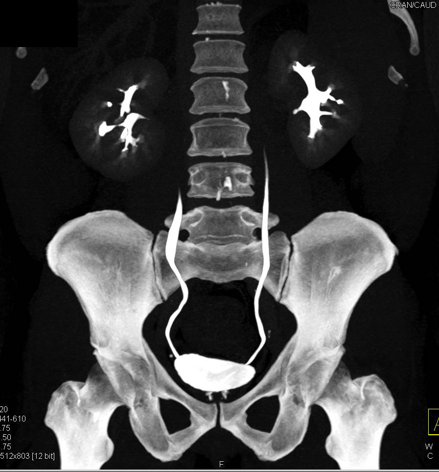 Normal CT Urogram Kidney Case Studies CTisus CT Scanning
