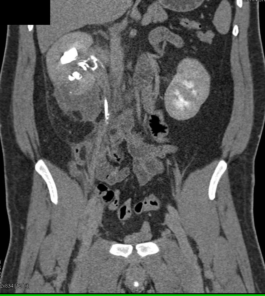Filling Defects Right Collecting System due to Blood Clots Kidney