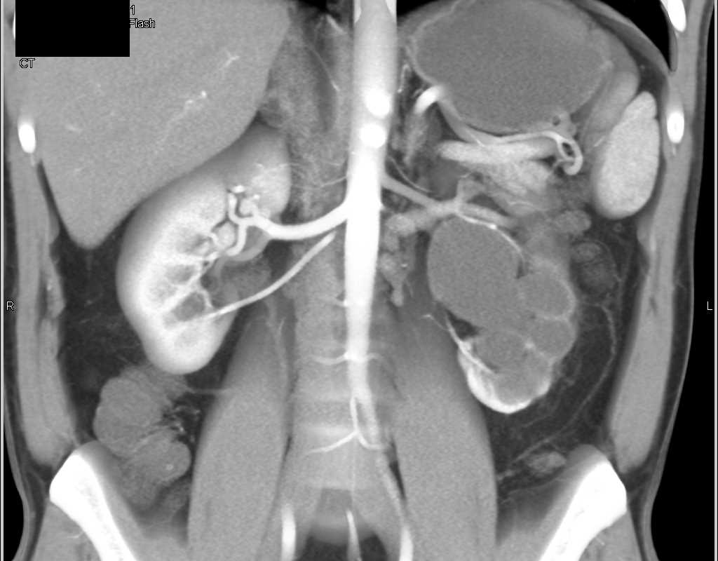 Obstructed Left Renal Pelvis with a UPJ Obstruction Kidney Case Studies CTisus CT Scanning