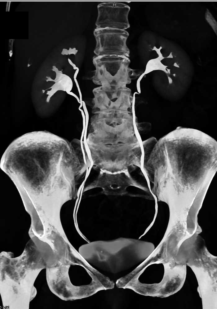 CT Urogram with Duplicated Collecting System Right Kidney