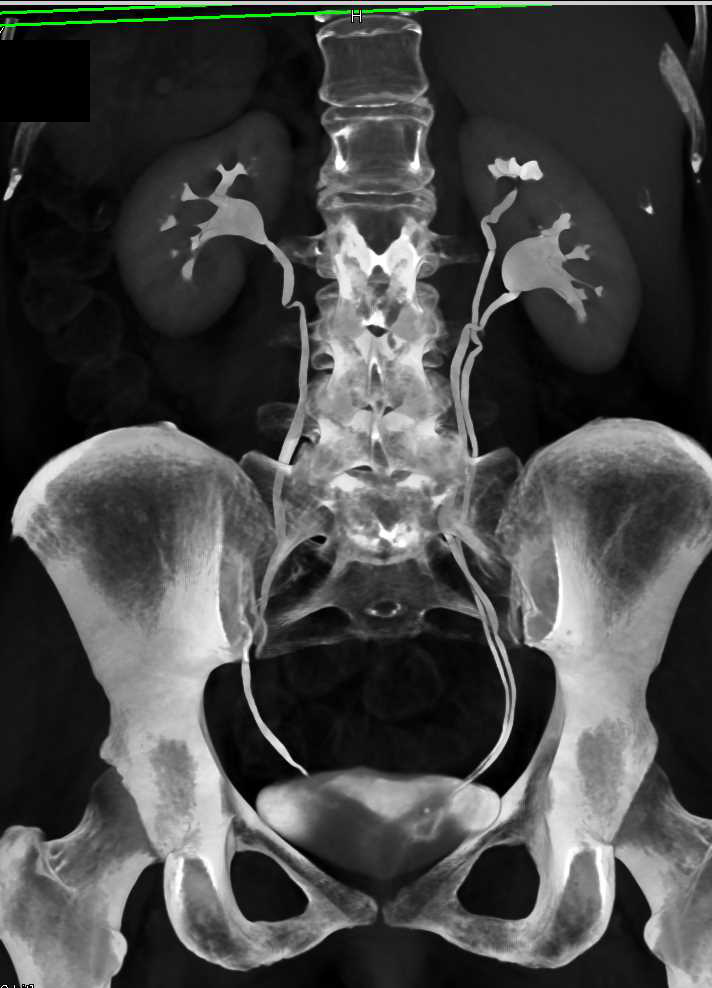 CT Urogram with Duplicated Collecting System Right Kidney Kidney Case