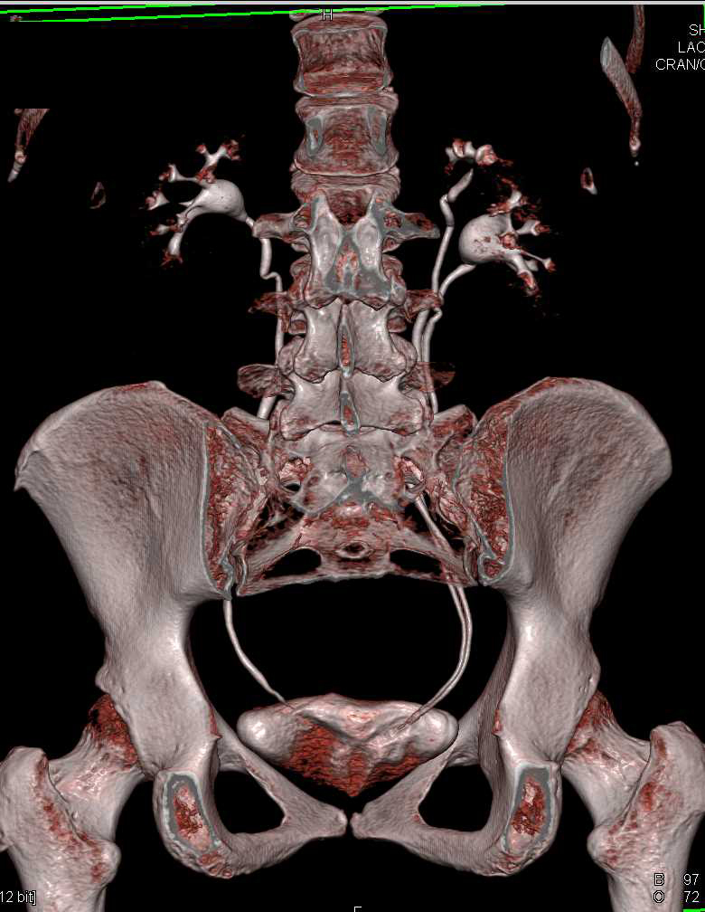 CT Urogram with Duplicated Collecting System Right Kidney