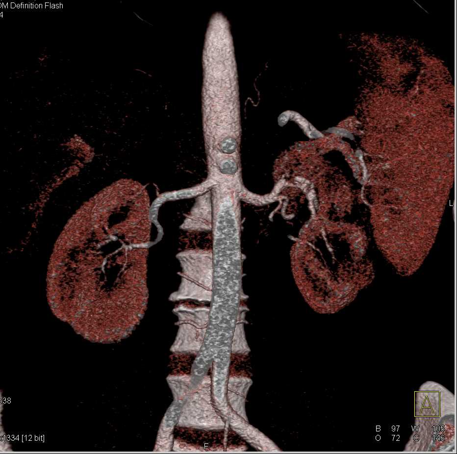 Clots in Left Renal Artery with Renal Infarction Kidney Case Studies