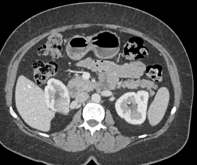 Renal Cell Carcinoma Upper Pole Right Kidney Kidney Case