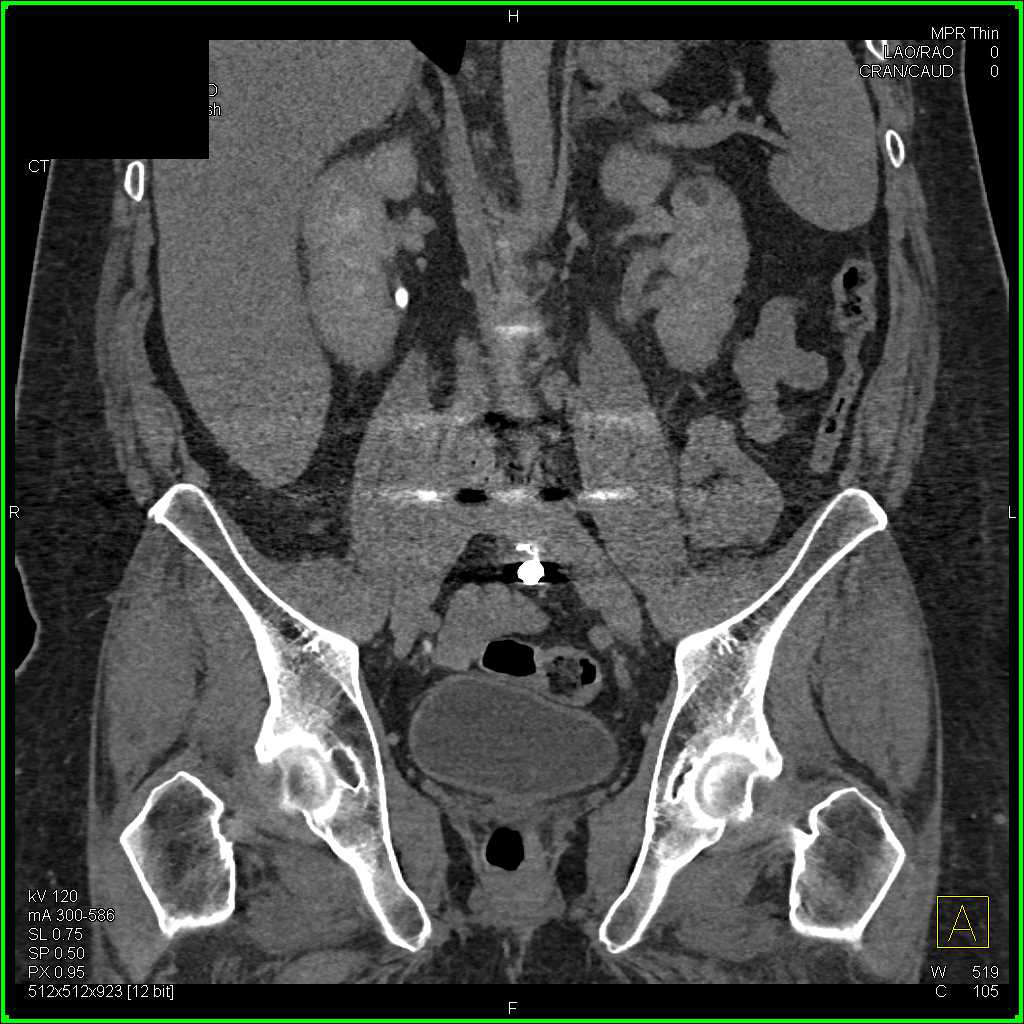 Incidental Left Bladder Wall Cancer Kidney Case Studies