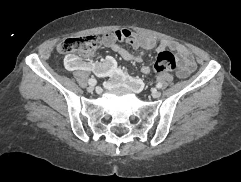 Pelvic Horseshoe Kidneys Kidney Case Studies CTisus CT Scanning