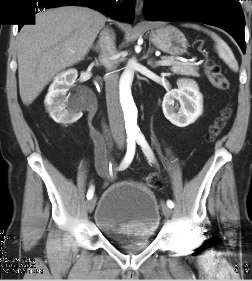 Duplicated Collecting System Right Kidney with Obstruction Kidney
