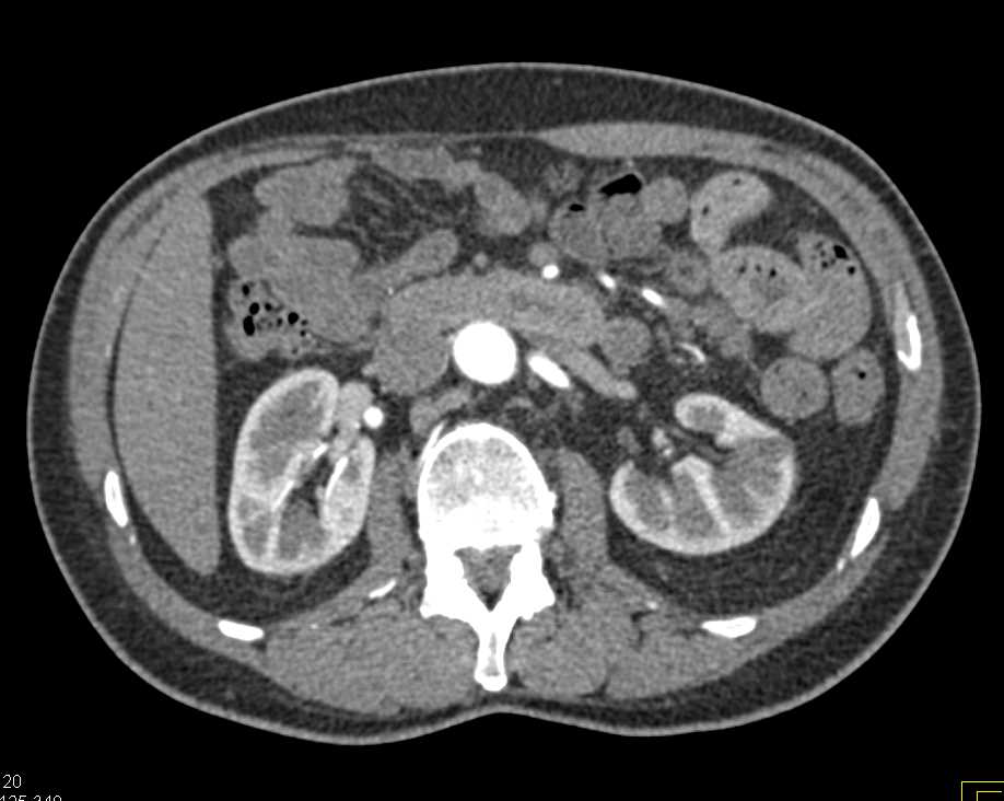 High Density Right Renal Cyst on Multiple Phases Kidney Case Studies