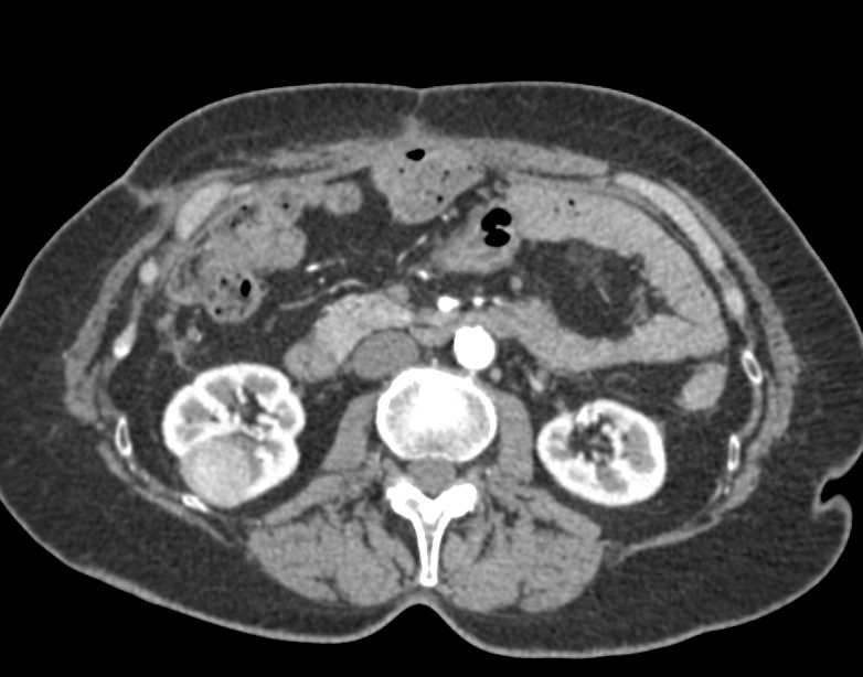 Oncocytoma Right Kidney Kidney Case Studies CTisus CT Scanning