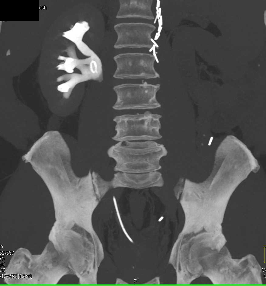 Stone in Right Renal Pelvis Kidney Case Studies CTisus CT Scanning