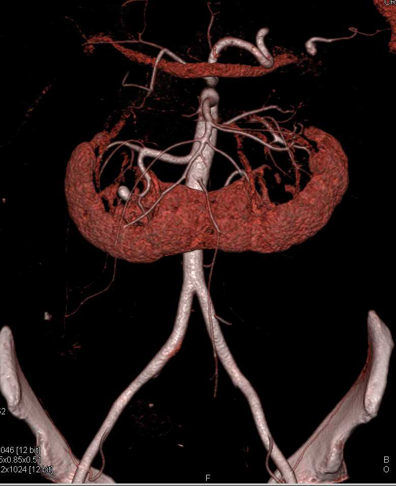 Horseshoe Kidney with Calculus but Normal Function Kidney Case