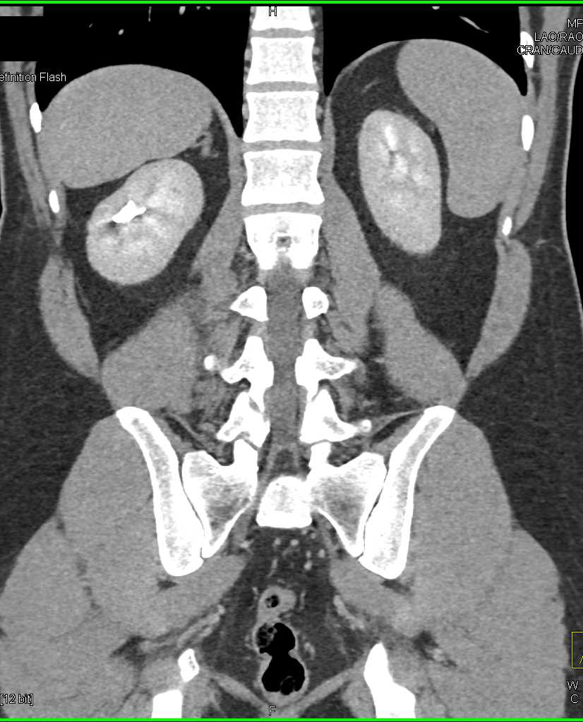 Normal CT Urography Kidney Case Studies CTisus CT Scanning