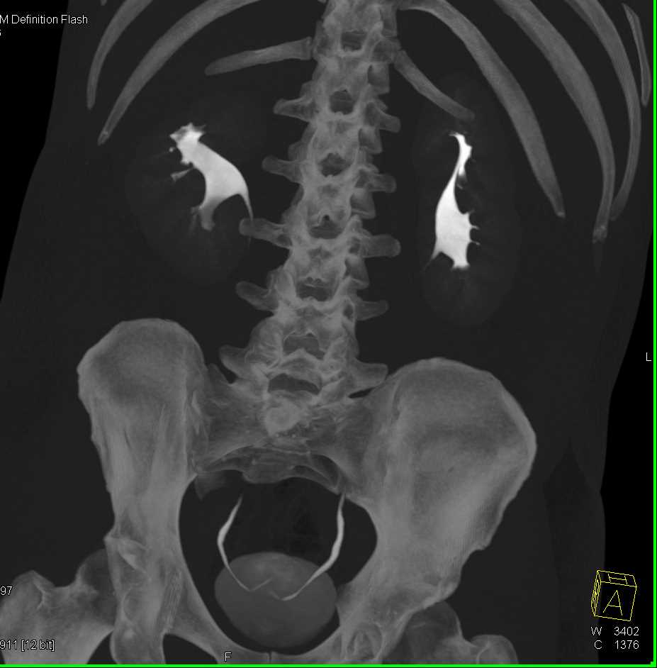 Normal CT Urography Kidney Case Studies CTisus CT Scanning