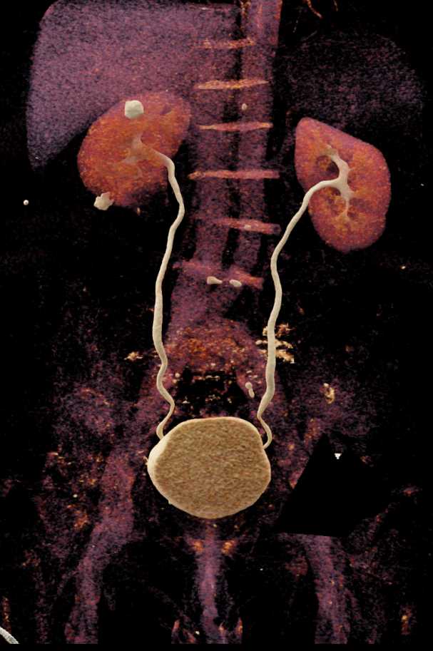High Density Renal Cysts Right kidney Kidney Case Studies CTisus CT