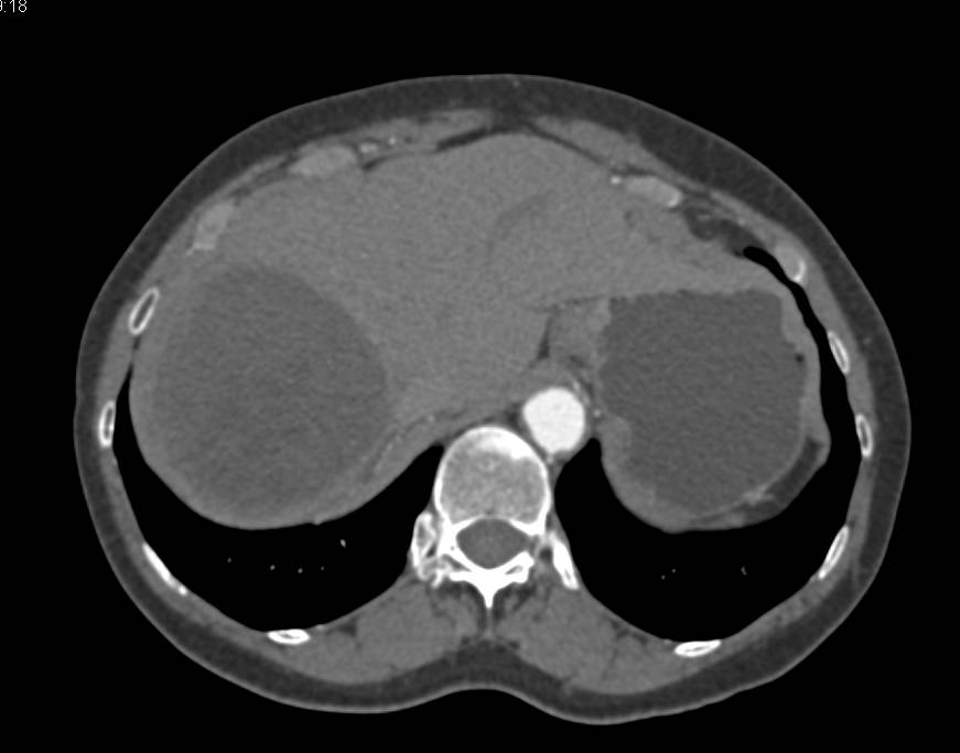 Hydatid Cyst in the LiverSee Additional Cyst or Daughter Cysts Liver