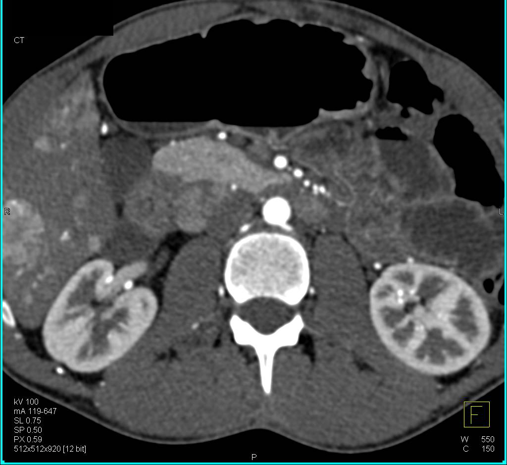 Metastatic Neuroendocrine Tumor to the Liver Liver Case Studies